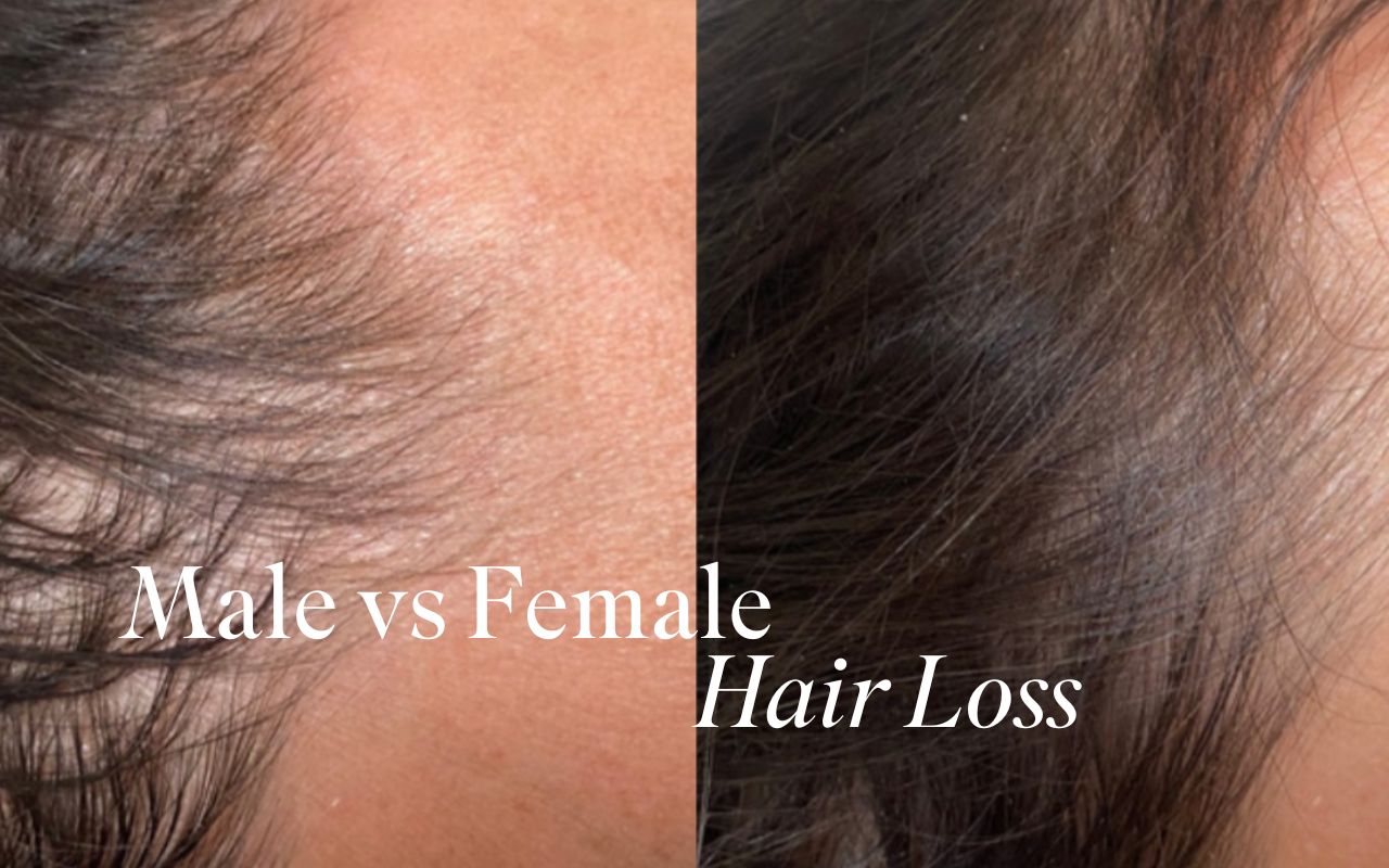 Title: Male vs. Female Hair Loss: What's the difference?
